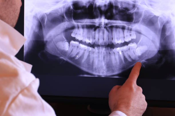 Best Emergency Tooth Extraction in Belcourt, ND